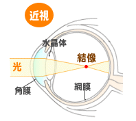 ①目の屈折異常｜あだち眼科