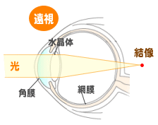 ①目の屈折異常|あだち眼科 ①目の屈折異常|あだち眼科