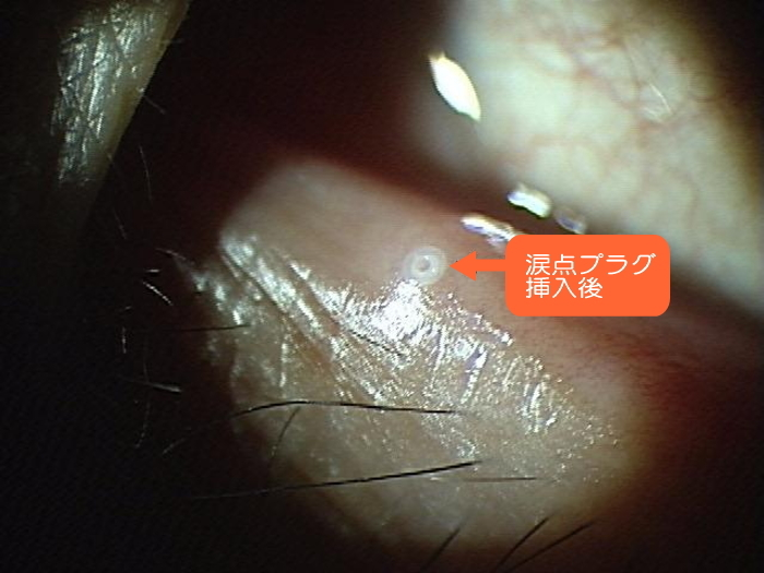 涙点プラグ挿入後